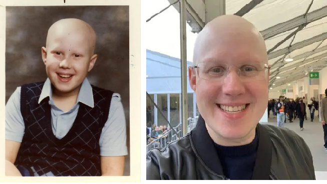 matt lucas hair loss