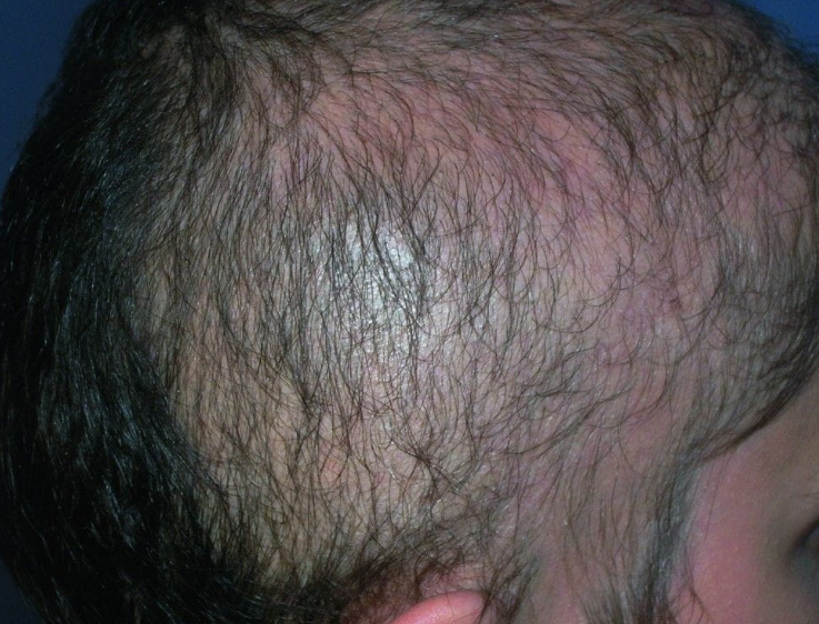 person with Trichotillomania