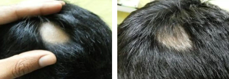 Minoxidil Spray: Uses, Effectiveness, Side Effects, Wimpole Clinic