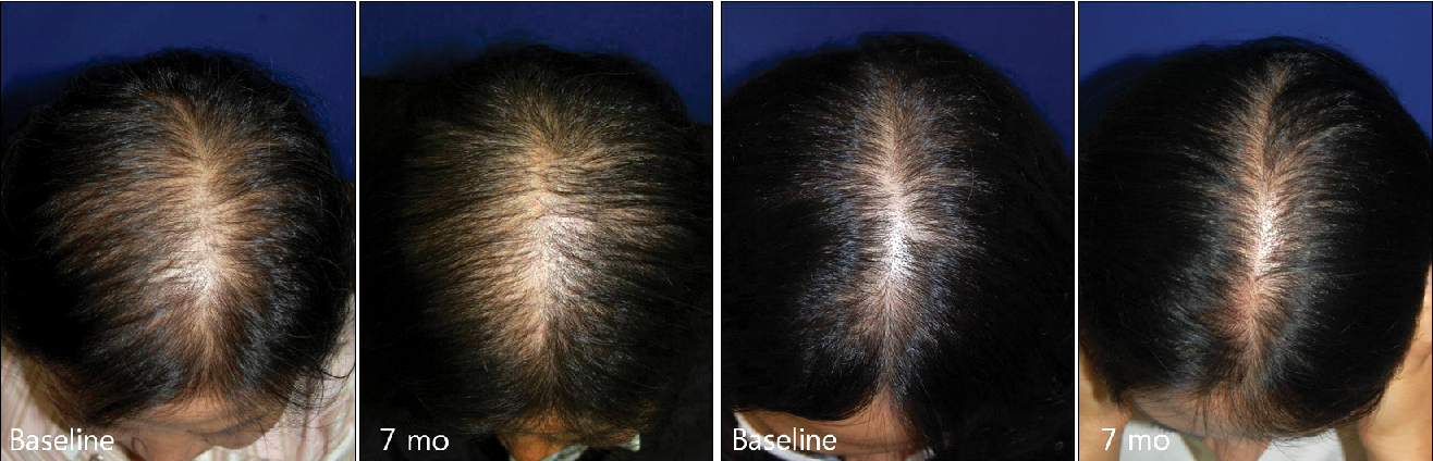 12 Proven Ways To Reverse Thinning Hair After Menopause, Wimpole Clinic