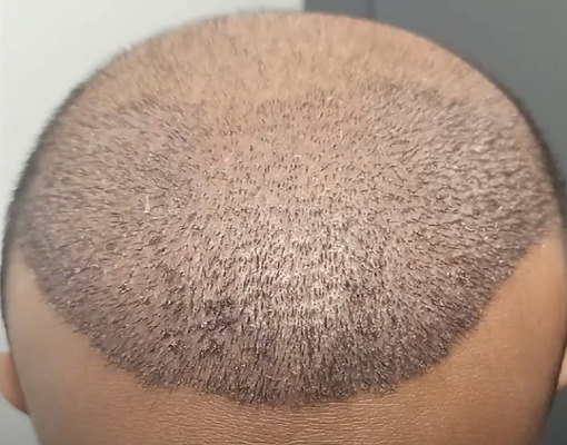 scalp 10 days after hair transplant featured image