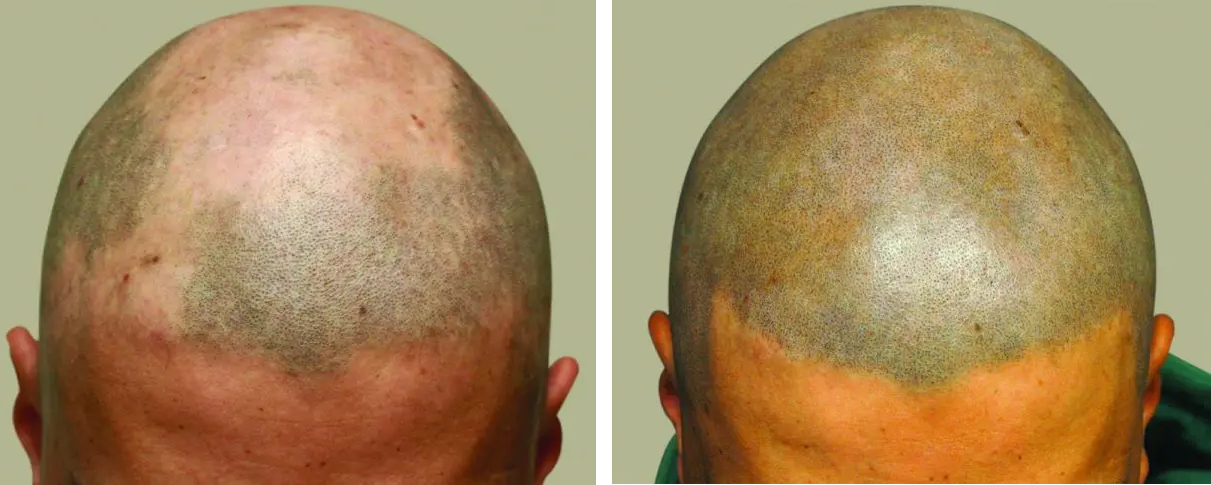 Hair Transplant Alternatives, Wimpole Clinic