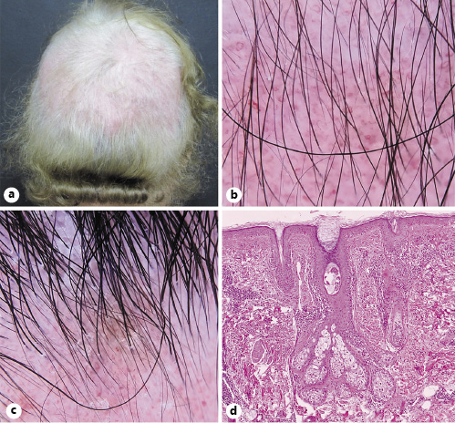 Burning Scalp Hair Loss: Causes, Diagnosis &#038; Treatment, Wimpole Clinic