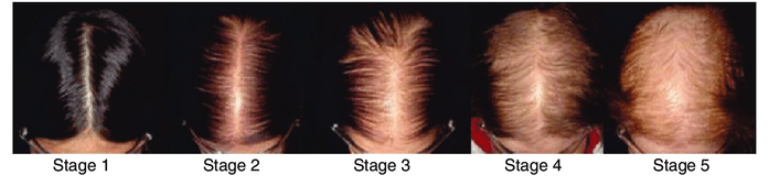 Sinclair scale used to diagnose the stage of hair loss in female pattern baldness