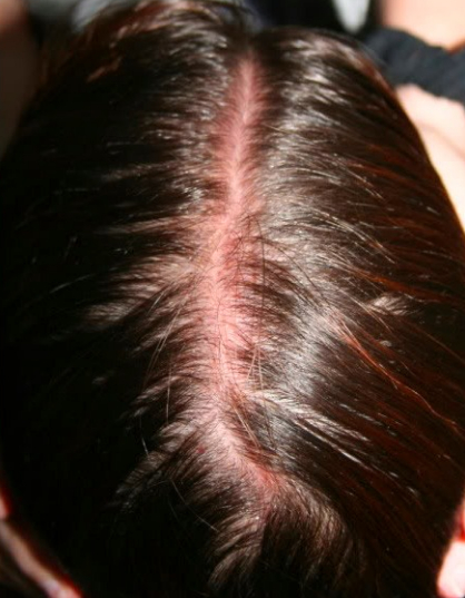 7 Reasons Your Scalp Is Tender in One Spot &#038; How To Treat Them, Wimpole Clinic