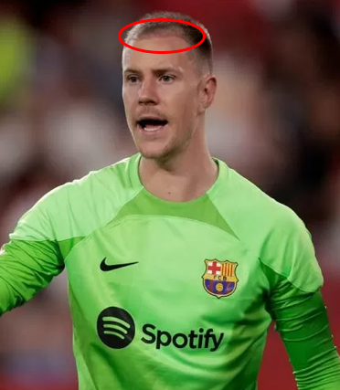 ter Stegen with possible hair grafts on his hairline