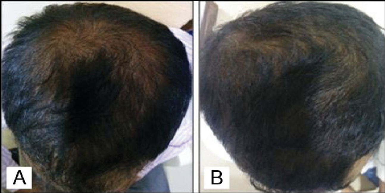 Before and after using 5% Minoxidil once a day for six months