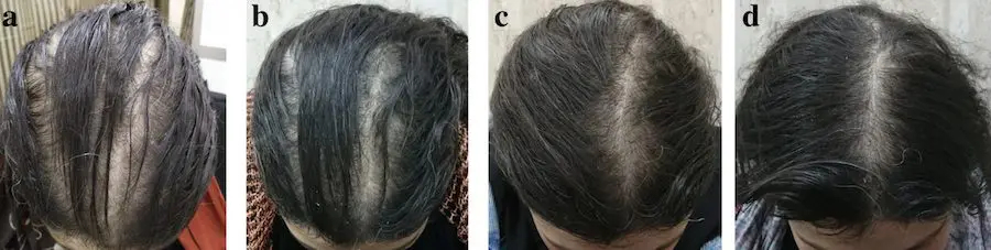 Hair growth progress over six months of 2% Minoxidil use