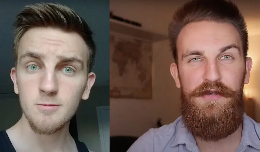 YouTuber Kaz Veselka after 1.5 years of Minoxidil use