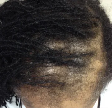 traction alopecia example