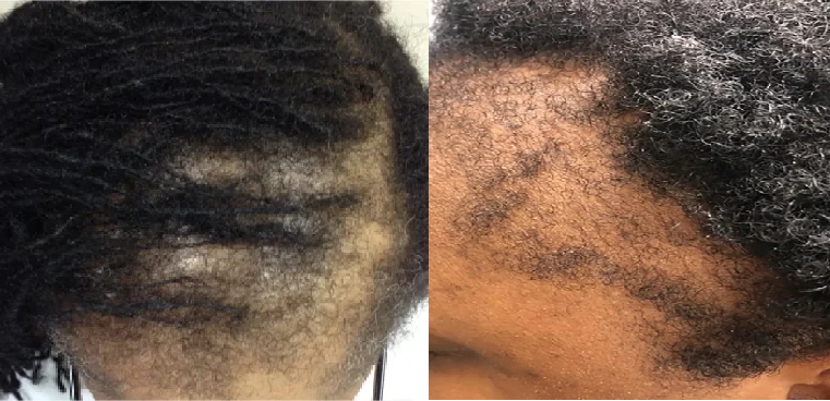 examples of traction alopecia