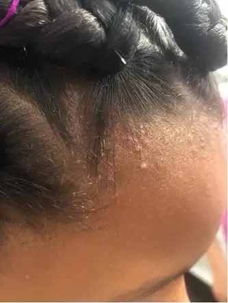 traction alopecia folliculitis